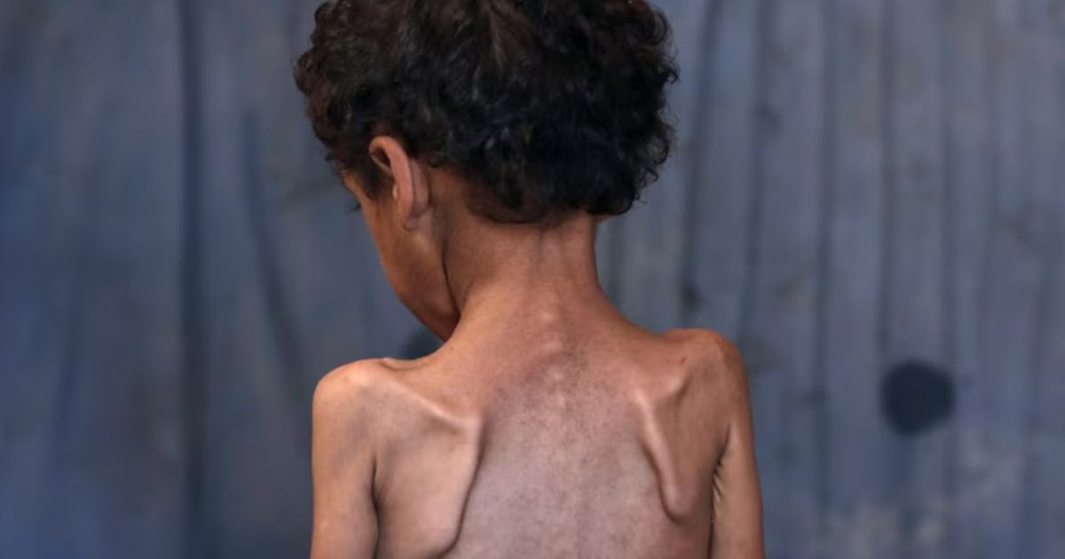 Save the Children  fëmijët e uritur në Gazë nuk kanë forcë as të qajnë