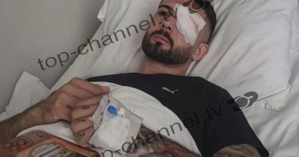  Plumbin e kam ende në sy    Vishkulli rrëfen momentin e plagosjes në protestë  rrezikon të humbasë shikimin  Video 